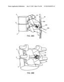 SYSTEMS AND METHODS FOR POSTERIOR DYNAMIC STABILIZATION OF THE SPINE diagram and image