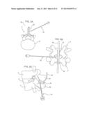 SYSTEMS AND METHODS FOR POSTERIOR DYNAMIC STABILIZATION OF THE SPINE diagram and image