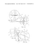 SYSTEMS AND METHODS FOR POSTERIOR DYNAMIC STABILIZATION OF THE SPINE diagram and image