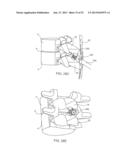 SYSTEMS AND METHODS FOR POSTERIOR DYNAMIC STABILIZATION OF THE SPINE diagram and image