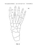 System and Method for Bone Fixation diagram and image