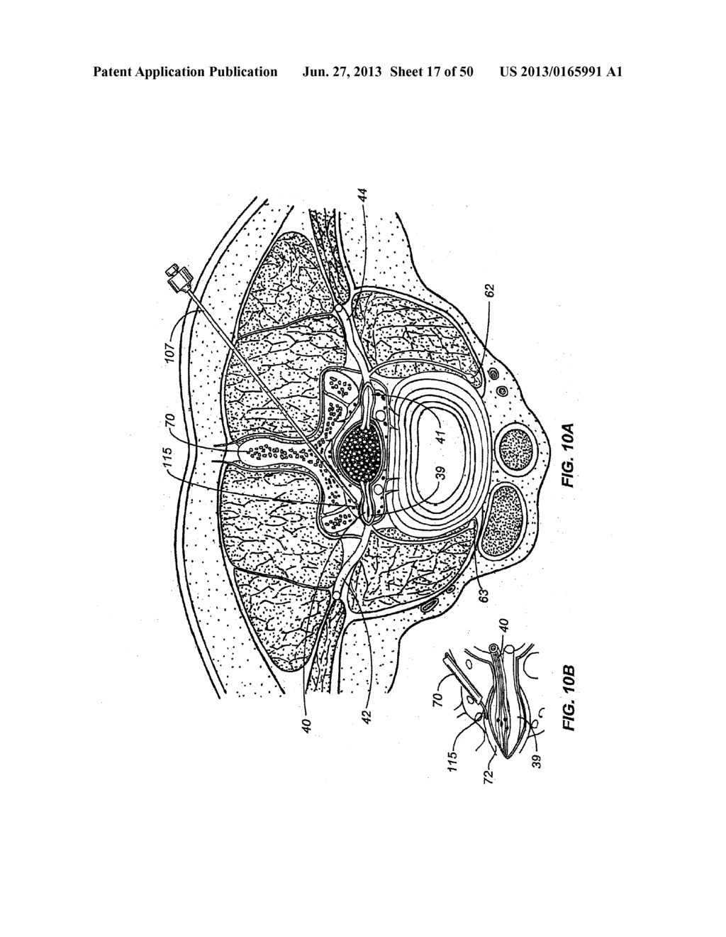 NEUROSTIMULATION METHODS AND SYSTEMS - diagram, schematic, and image 18