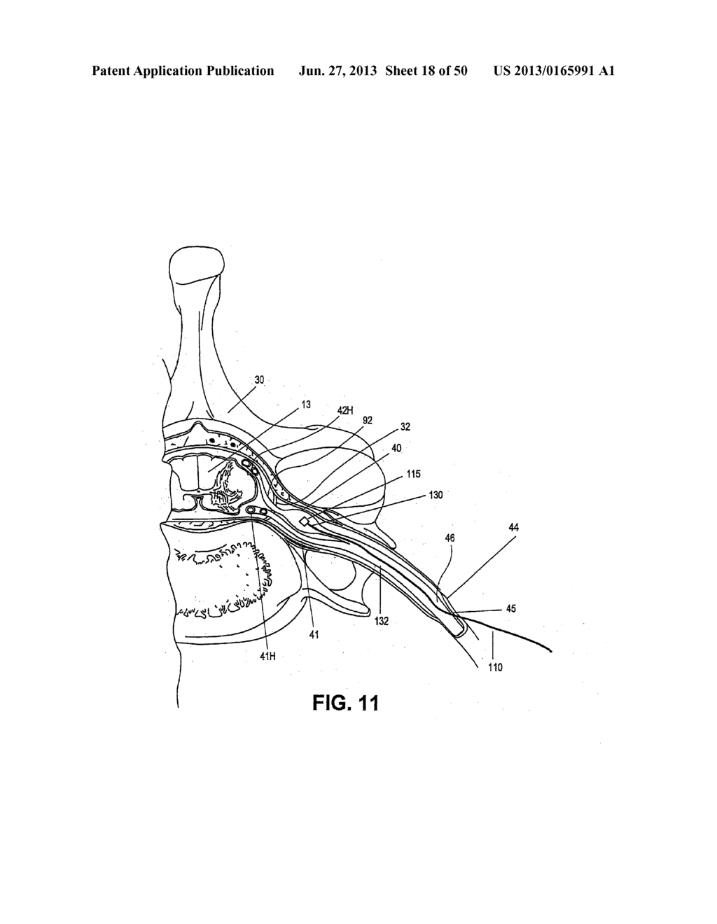 NEUROSTIMULATION METHODS AND SYSTEMS - diagram, schematic, and image 19