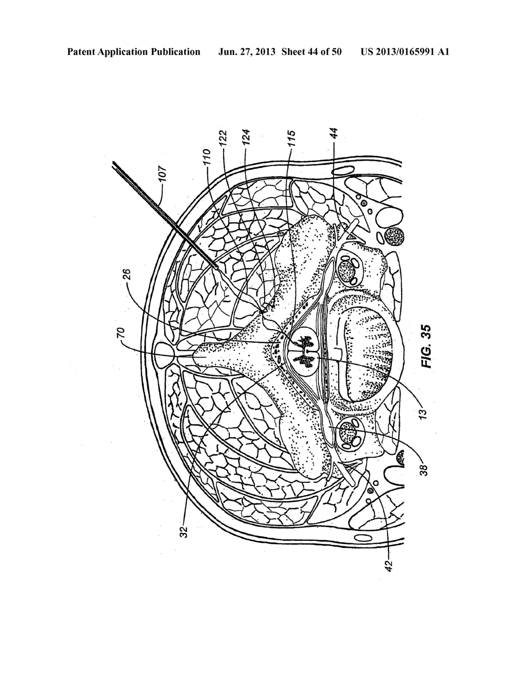 NEUROSTIMULATION METHODS AND SYSTEMS - diagram, schematic, and image 45