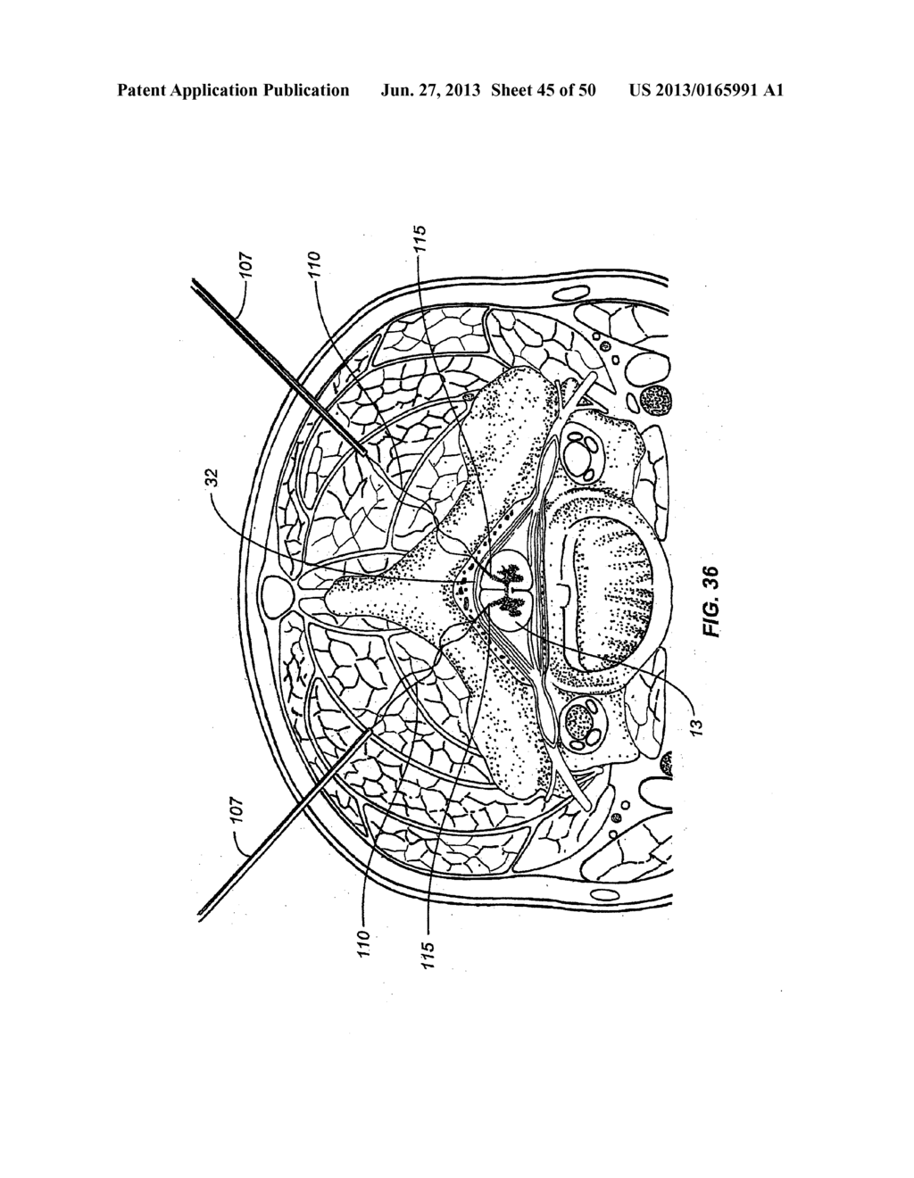 NEUROSTIMULATION METHODS AND SYSTEMS - diagram, schematic, and image 46