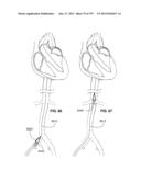 Actively Controllable Stent, Stent Graft, Heart Valve and Method of     Controlling Same diagram and image