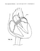 Actively Controllable Stent, Stent Graft, Heart Valve and Method of     Controlling Same diagram and image