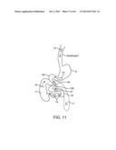 THERAPEUTIC AGENT PREPARATIONS FOR DELIVERY INTO A LUMEN OF THE INTESTINAL     TRACT USING A SWALLOWABLE DRUG DELIVERY DEVICE diagram and image