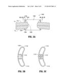 WOUND PROTECTOR WITH REINFORCED RING diagram and image