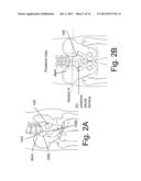 DEVICES AND METHODS FOR THE DIAGNOSIS AND TREATMENT OF SACRO-ILIAC JOINT     DISEASE diagram and image