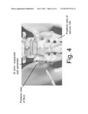 DEVICES AND METHODS FOR THE DIAGNOSIS AND TREATMENT OF SACRO-ILIAC JOINT     DISEASE diagram and image