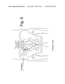 DEVICES AND METHODS FOR THE DIAGNOSIS AND TREATMENT OF SACRO-ILIAC JOINT     DISEASE diagram and image