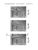 DEVICES AND METHODS FOR THE DIAGNOSIS AND TREATMENT OF SACRO-ILIAC JOINT     DISEASE diagram and image