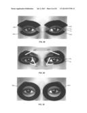 DRY EYE TREATMENT APPARATUS AND METHODS diagram and image