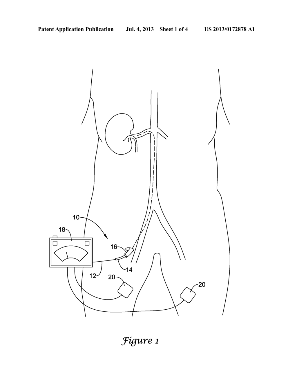 DEVICE AND METHODS FOR RENAL NERVE MODULATION MONITORING - diagram, schematic, and image 02