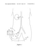 RENAL NERVE MODULATION MEDICAL DEVICES diagram and image