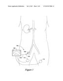 OFF-WALL ELECTRODE DEVICE AND METHODS FOR NERVE MODULATION diagram and image