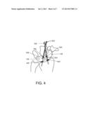 SCAPHO-LUNATE AND OTHER LIGAMENT AND BONE REPAIR/RECONSTRUCTION diagram and image