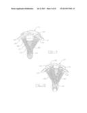 ORTHOPEDIC COMPRESSION PLATE AND METHOD OF SURGERY diagram and image