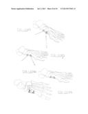 ORTHOPEDIC COMPRESSION PLATE AND METHOD OF SURGERY diagram and image