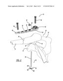 SUTURE BUTTON diagram and image