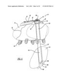 SUTURE BUTTON diagram and image