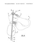 SUTURE BUTTON diagram and image