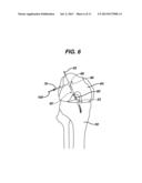 METHODS FOR LIGAMENT RECONSTRUCTION diagram and image