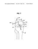 METHODS FOR LIGAMENT RECONSTRUCTION diagram and image
