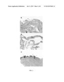 GENE EXPRESSION PROFILES AND PRODUCTS FOR THE DIAGNOSIS AND PROGNOSIS OF     POSTINJURY SYNOVITIS AND OSTEOARTHRITIS diagram and image