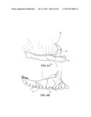 METHODS, INSTRUMENTS AND DEVICES FOR EXTRAGASTIC REDUCTION OF STOMACH     VOLUME diagram and image