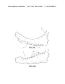 METHODS, INSTRUMENTS AND DEVICES FOR EXTRAGASTIC REDUCTION OF STOMACH     VOLUME diagram and image