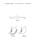 METHODS, INSTRUMENTS AND DEVICES FOR EXTRAGASTIC REDUCTION OF STOMACH     VOLUME diagram and image