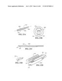 METHODS, INSTRUMENTS AND DEVICES FOR EXTRAGASTIC REDUCTION OF STOMACH     VOLUME diagram and image