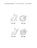 METHODS, INSTRUMENTS AND DEVICES FOR EXTRAGASTIC REDUCTION OF STOMACH     VOLUME diagram and image