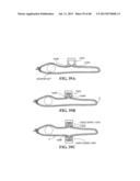 METHODS, INSTRUMENTS AND DEVICES FOR EXTRAGASTIC REDUCTION OF STOMACH     VOLUME diagram and image