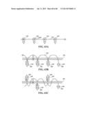 METHODS, INSTRUMENTS AND DEVICES FOR EXTRAGASTIC REDUCTION OF STOMACH     VOLUME diagram and image