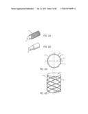 MINIMALLY INVASIVE TISSUE SUPPORT diagram and image