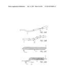 MINIMALLY INVASIVE TISSUE SUPPORT diagram and image