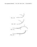 MINIMALLY INVASIVE TISSUE SUPPORT diagram and image