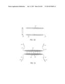 MINIMALLY INVASIVE TISSUE SUPPORT diagram and image