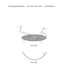 MINIMALLY INVASIVE TISSUE SUPPORT diagram and image