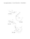 MINIMALLY INVASIVE TISSUE SUPPORT diagram and image