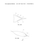 MINIMALLY INVASIVE TISSUE SUPPORT diagram and image