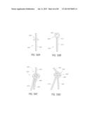 MINIMALLY INVASIVE TISSUE SUPPORT diagram and image