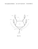 MINIMALLY INVASIVE TISSUE SUPPORT diagram and image