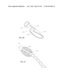 MINIMALLY INVASIVE TISSUE SUPPORT diagram and image