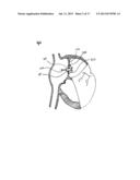 METHODS AND DEVICES FOR INTRA-ATRIAL SHUNTS HAVING ADJUSTABLE SIZES diagram and image