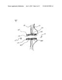 METHODS AND DEVICES FOR INTRA-ATRIAL SHUNTS HAVING ADJUSTABLE SIZES diagram and image