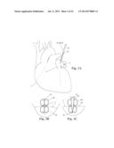 DEVICES AND METHODS FOR MINIMALLY-INVASIVE SURGICAL PROCEDURES diagram and image